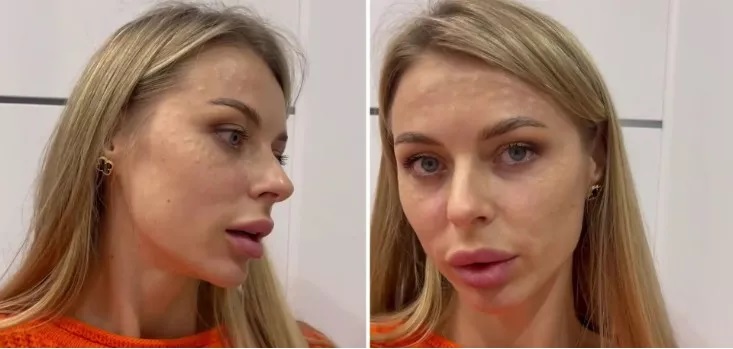 «Кинули в чорний список та видалили листування»: красуню-дружину ексфутболіста збірної України понівечив косметолог (фото)