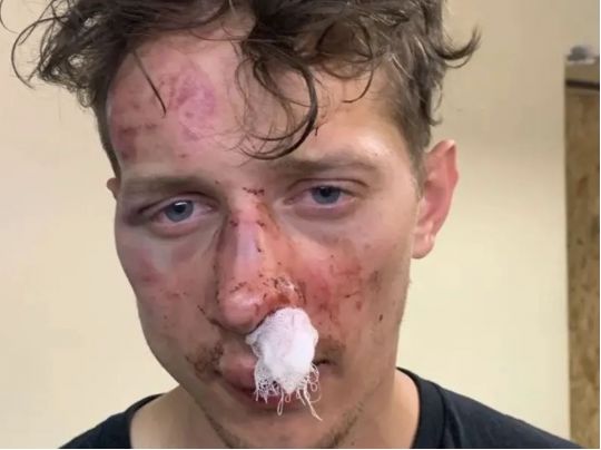 У Києві ветерана війни жорстоко побили через зачіску